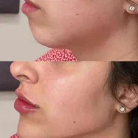 ژل .بوتاکس .هایفو.ساکشن غبغب وساکشن شکم وپهلو|خدمات آرایشگری و زیبایی|اصفهان, رکن الدوله غربی|دیوار