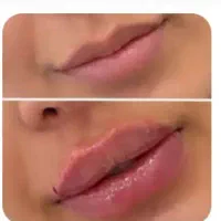 آفر ویژه بوتاکس،ژل،فیلر، لیفت با نخ، مزو تراپی