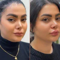 تزریق ژل لب فیلر بوتاکس۲۸۵و مزو لیفت کانتورینگ