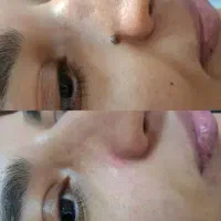 خالبرداری و رفع انواع خال در کلینیک تخصصی پوست|خدمات زیبایی و سلامت|اهواز, کیانپارس |دیوار