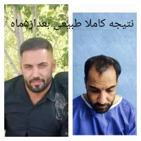 کاشت مووابروشیرازی حرفه ای شروع از۲۰تومن|خدمات زیبایی و سلامت|تهران, صد دستگاه|دیوار