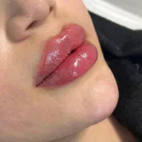 تزریقات ژل .بوتاکس .آنزیم .مزو ژل .مزوسر ضمانتی|خدمات آرایشگری و زیبایی|خرم‌آباد, |دیوار