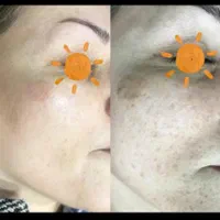 رفع انواع خال کک مک لک بادستگاه پیشرفته|خدمات آرایشگری و زیبایی|یاسوج, |دیوار