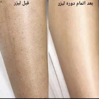 لیزرموزائد سوپرانوتیتانیوم آلما اصلی ۴۹۰تومن|خدمات آرایشگری و زیبایی|گرگان, |دیوار
