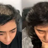 تخفیف ویژه مزوتراپی و پی آر پی مو واسکالپ سر