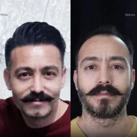 اقتصادی ترین کلینیک کاشت مو و ابرو در تهران/ اقساط|خدمات آرایشگری و زیبایی|تهران, سعادت‌آباد|دیوار