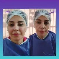 تزریق چربی،ساکشن،زاویهسازی،بلفارو،رفع افتادگی ابرو