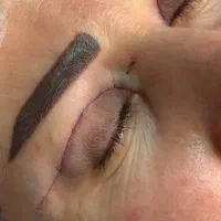 بلفاروپلاستی