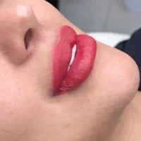 بوتاکس رایگان به شرط هایفوتراپی صورت غبغب