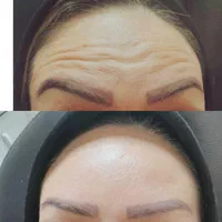 بوتاکس ژل فیلر فیلربادی مزوتراپی پی آر پی در مطب|خدمات آرایشگری و زیبایی|زنجان, |دیوار