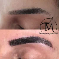حذف تتو از صورت شما|خدمات آرایشگری و زیبایی|اهواز, کیانپارس |دیوار