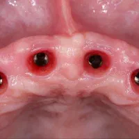 دندانپزشکی ایمپلنت روکش ارتودنسی اقساطی|خدمات آرایشگری و زیبایی|مرند, |دیوار