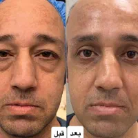 بلفاروپلاستی پلک|خدمات آرایشگری و زیبایی|تهران, یوسف‌آباد|دیوار