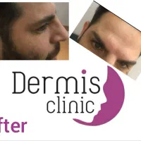 بوتاکس  فول فیس مصپورت اصلی ۵۵۰تومن بشرط اصالت|خدمات آرایشگری و زیبایی|ری, دولت‌آباد|دیوار