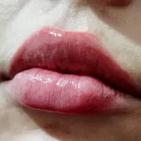 بوتاکس فیلرژل مزو میکروشیدینگ|خدمات آرایشگری و زیبایی|کرج, مشکین‌دشت|دیوار