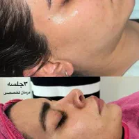 پاکسازی و فیشیال تخصصی و پلاژن تراپی ( فیشال )|خدمات آرایشگری و زیبایی|شیراز, شهرک قمشه|دیوار