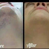 فیشال بوتاکس مزو پی آر پی لیزر بدن prp پی ارپی|خدمات آرایشگری و زیبایی|مشهد, هفت تیر (حافظ)|دیوار