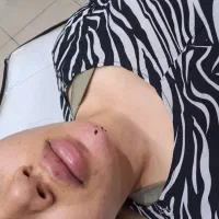 تزریق فیلر و بوتاکس با ماندگاری و نتیجه طبیعی|خدمات آرایشگری و زیبایی|تهران, مهرآباد|دیوار