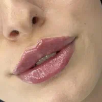 تزریق ژل و بوتاکس هیرفیلر و لیزر توسط پزشک