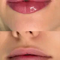 بوتاکس فیلر میدفیس توسط پزشک انزیم اموزش ژل