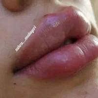 تزریق ژل فیلر تضمینی بوتاکس پرسینگ چاله گونه|خدمات آرایشگری و زیبایی|قم, نیروگاه|دیوار