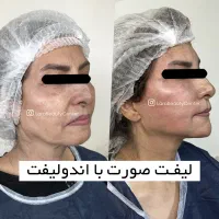 جوانسازی لیفت صورت اندولیفت هایفو تخفیف ویژه|خدمات آرایشگری و زیبایی|تهران, صادقیه|دیوار
