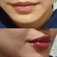 بوتاکس،انواع فیلر ومزوتراپی (وعمل های زیبایی زنان)
