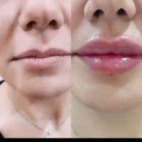 تزریق ژل،بوتاکس درمکانی مستقل بارعایت اصول بهداشتی|خدمات آرایشگری و زیبایی|زاهدان, |دیوار