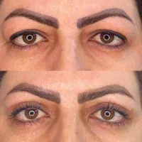 خال برداری، پاک کردن تتو، بلفاروپلاستی در تهران|خدمات آرایشگری و زیبایی|باقرشهر, |دیوار