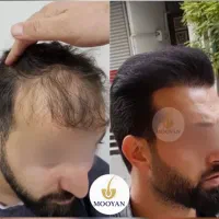 جشنواره‌کاشت‌مو(VIP)۲۴تومن کاشت ابرو۱۴‌(اقساطی)