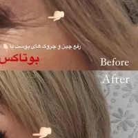 ژل بوتاکس مزوتراپی فیلرکانتورینگ|خدمات آرایشگری و زیبایی|چهارباغ, |دیوار