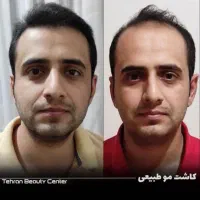 کاشت مو /کاشت ابرو /عمل بینی/پی آرپی/مزوتراپی
