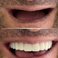 دندانپزشکی اقساطی(ایمپلنت،کامپوزیت،لمینیت)