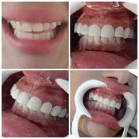 مژده مژده کامپوزیت برای یک ماه  تخفیف ویژه|خدمات آرایشگری و زیبایی|یاسوج, |دیوار