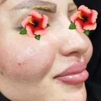 ژل، پرسینگ، چال گونه