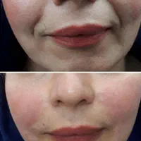 تزریق ژل (فیلر) و بوتاکس|خدمات آرایشگری و زیبایی|شیراز, عادل آباد|دیوار