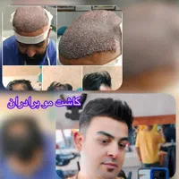 کاشت مو و ابرو در تبریز، پیش پرداخت ۶میلیون|خدمات آرایشگری و زیبایی|اردبیل, |دیوار