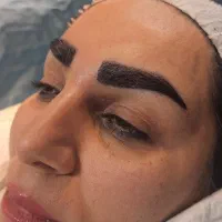 کاشت ابرو کلینیک تخصصی رویال