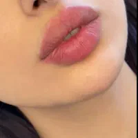 فیلر، ژل، بوتاکس ،لیفت شقیقه،کانتورینگ دایرکت ابرو