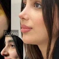 رینوپلاستی عمل زیبایی بینی و ترمیم