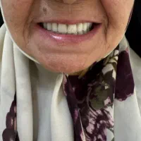 دندان مصنوعی ژله ای