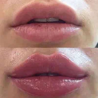 خدمات ژل و بوتاکس|خدمات آرایشگری و زیبایی|شیراز, نصرآباد|دیوار