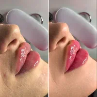 تزریق ژل لب فیلر زاویه سازی صورت فک گونه بوتاکس|خدمات آرایشگری و زیبایی|فردیس, خیام شرقی|دیوار