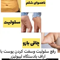 پاک کردن انواع تتو لاغری موضعی لیزر موهای زاید|خدمات آرایشگری و زیبایی|شیراز, حافظیه|دیوار