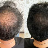 فیبروز(میکروبلیدینگ)،شیدینگ لب ،اسکالپ
