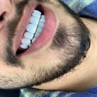 آف کامپوزیت به مدت محدود
