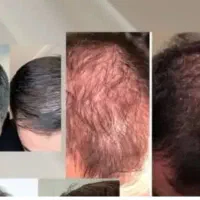 قطعی ریزش مو و رویش مجدد|آرایشی، بهداشتی، درمانی|اهواز, طالقانی|دیوار