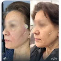 جشنواره لیفت فیلربوتاکس بلفارو نخ تزریق چربی فشیال|خدمات آرایشگری و زیبایی|اصفهان, ملکشهر|دیوار