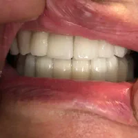 دندان مصنوعی/فلیپر/روکش دندان/دندان طلا/پروتزدندان
