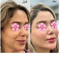 جشنوارلیفت/جوانسازی/هایفو/فقط1جلسه باهدیه عالی۸۹۰|خدمات آرایشگری و زیبایی|اصفهان, لاله|دیوار